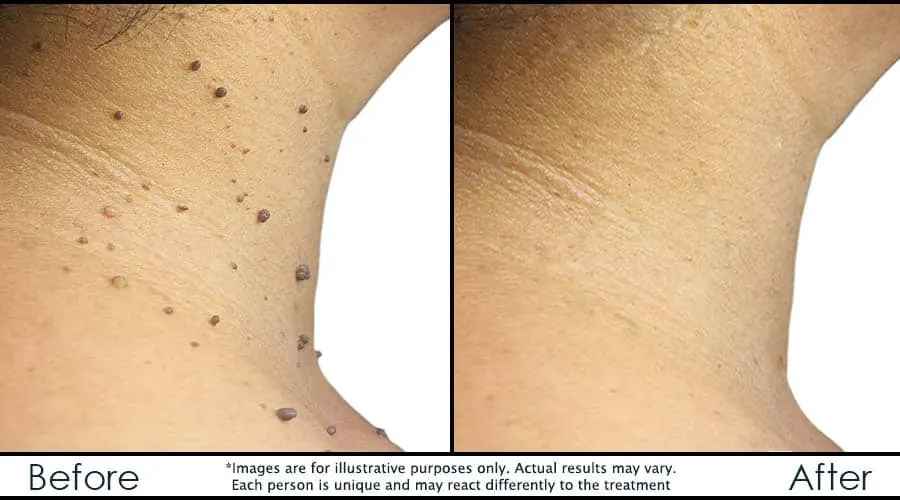 Best Skin Tag Removal Treatment in Kitchener